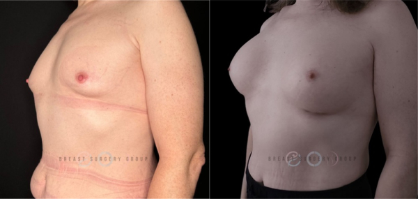 10164-male-to-female-n-top-surgery-before-after-photo-nyc