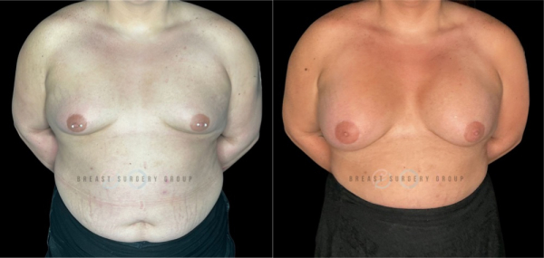 10507-male-to-female-n-top-surgery-before-after-photo-nyc