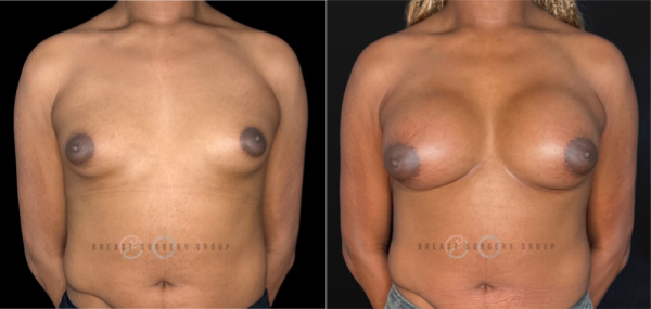 12065-top-surgery-m-to-f-plastic-surgery-before-and-after-photo