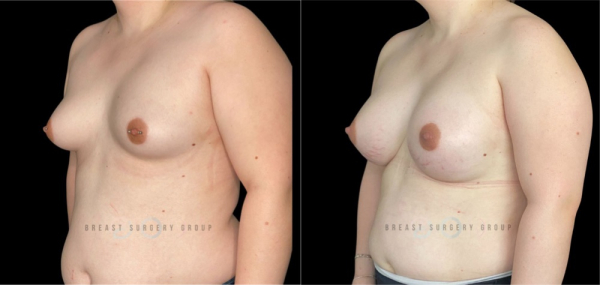 4309-male-to-female-n-top-surgery-before-after-photo-nyc
