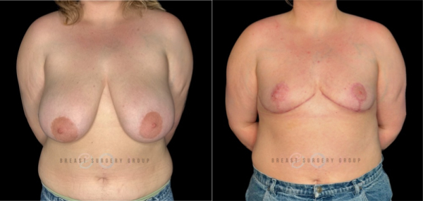 11159-top-surgery-gender-afferming-care-breast-reduction-plastic-surgery-before-and-after-photo-1-1 (1)