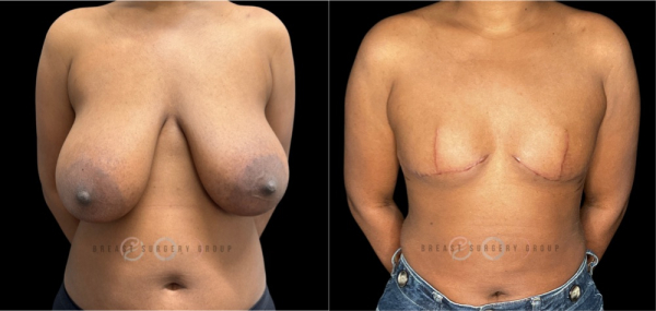 top-surgery-gender-affirming-radical-breast-reduction-1