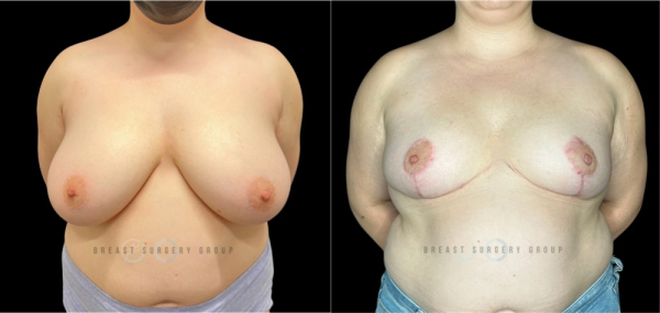 top-surgery-gender-affirming-radical-breast-reduction-2
