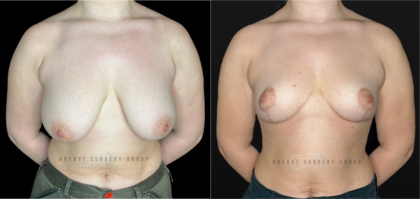 10842-gender-affirming-radical-breast-reduction-nyc-before-after-photo