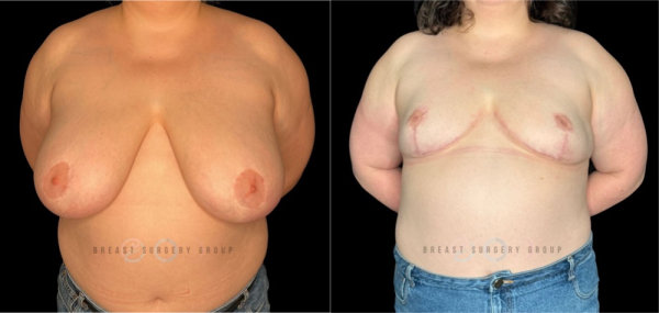 9417-top-surgery-gender-affirming-radical-breast-reduction
