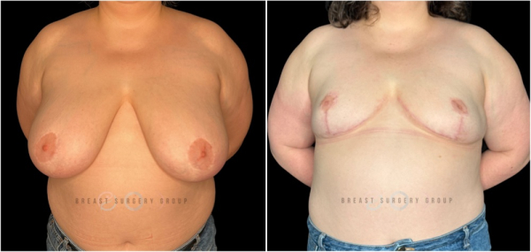 9417-top-surgery-gender-affirming-radical-breast-reduction (1)